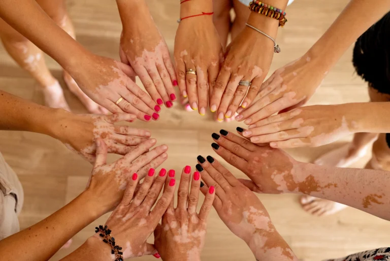 Bielactwo w moim obiektywie